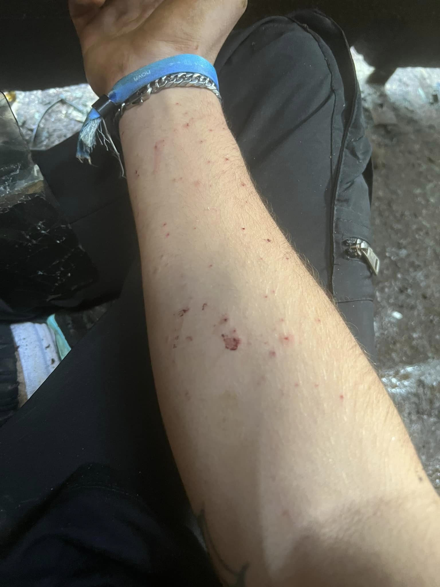 Wounds on the hand